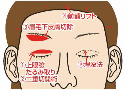 上眼瞼たるみ治療の種類イラスト