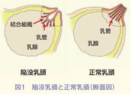 正常乳頭と陥没乳頭を比較するイラスト