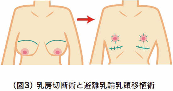 皮膚のたるみが高度で乳房の下垂がある場合は乳房切断術と乳輪乳頭遊離移植イラスト
