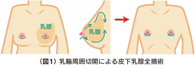 乳輪周囲切開による皮下乳腺全摘術イラスト
